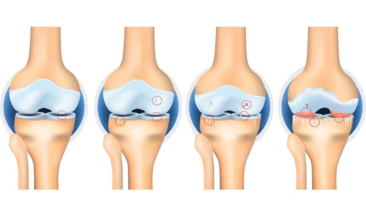 Osteoarthritis of the joints